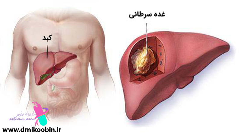  درمان سرطان کبد