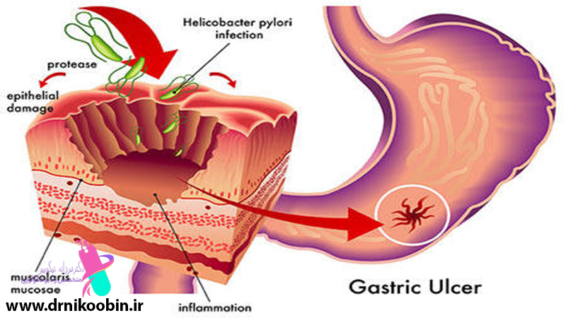 پیشگیری از سرطان معده