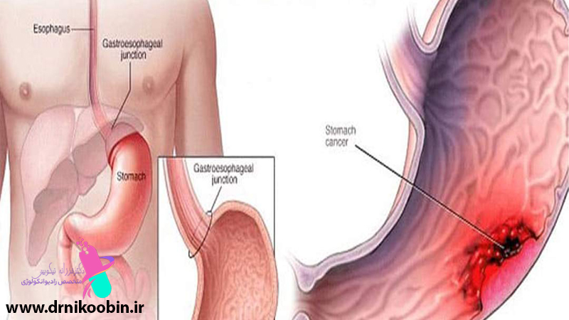 پیشگیری از سرطان معده