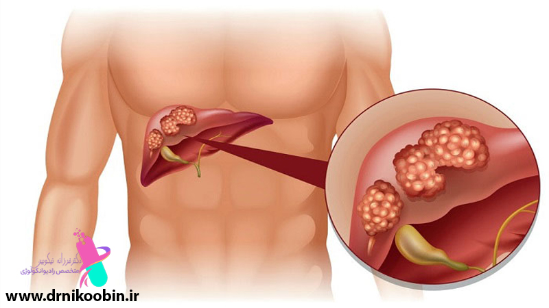  درمان سرطان کبد