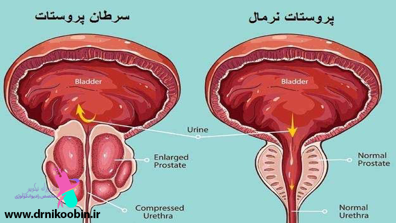 درمان-سرطان-پروستات
