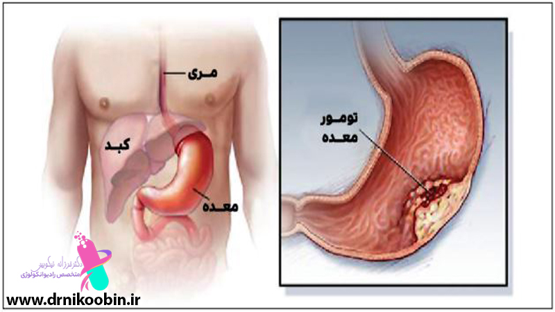 درمان سرطان معده