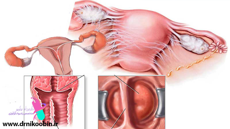 سرطان دستگاه تناسلی زنان