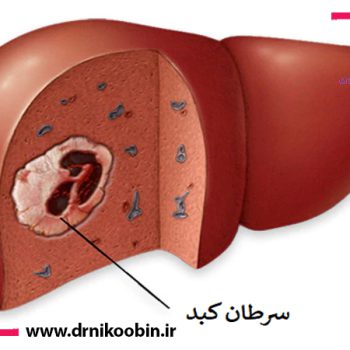 درمان سرطان کبد