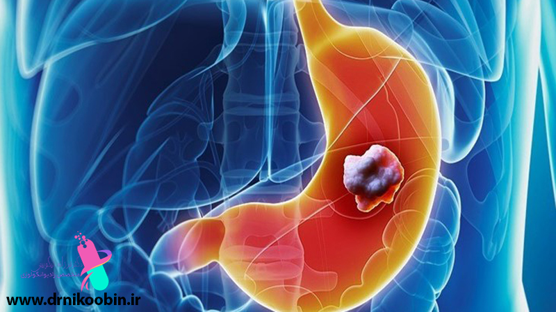 درمان سرطان معده