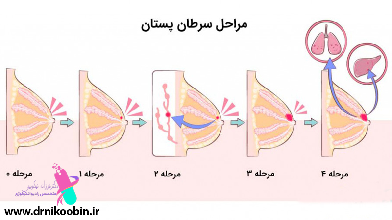 تشخیص زودهنگام سرطان سینه