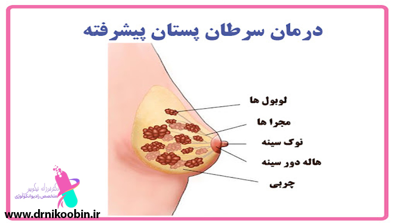 سرطان سینه در اصفهان