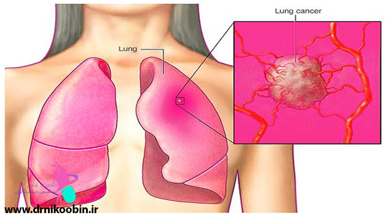 سرطان ریه در زنان اصفهان