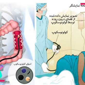 کولونوسکوپی در اصفهان