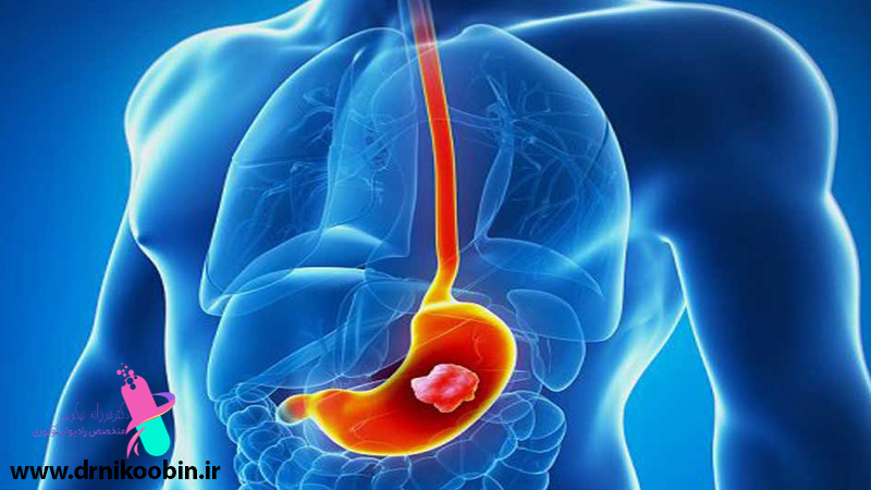سرطان دستگاه گوارش در اصفهان