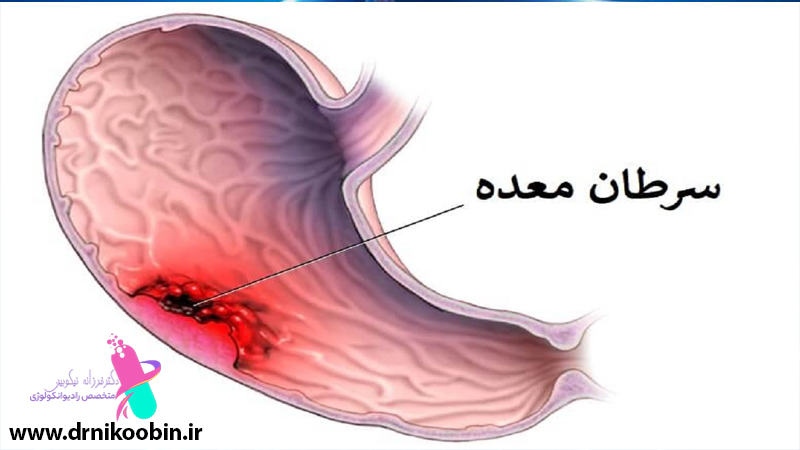 سرطان دستگاه گوارش در اصفهان