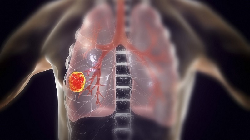 تشخیص و درمان سرطان ریه