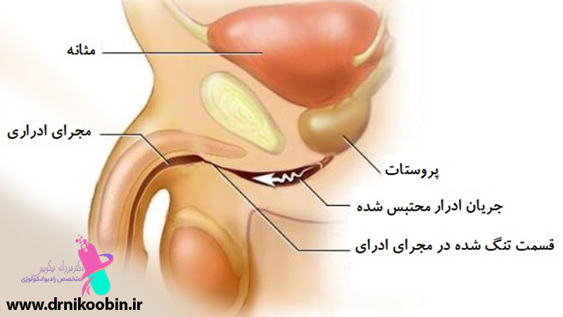 علائم کارسینوم مجرا