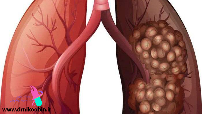 متخصص-رادیوانکولوژی-اصفهان | شیمی-درمانی-اصفهان