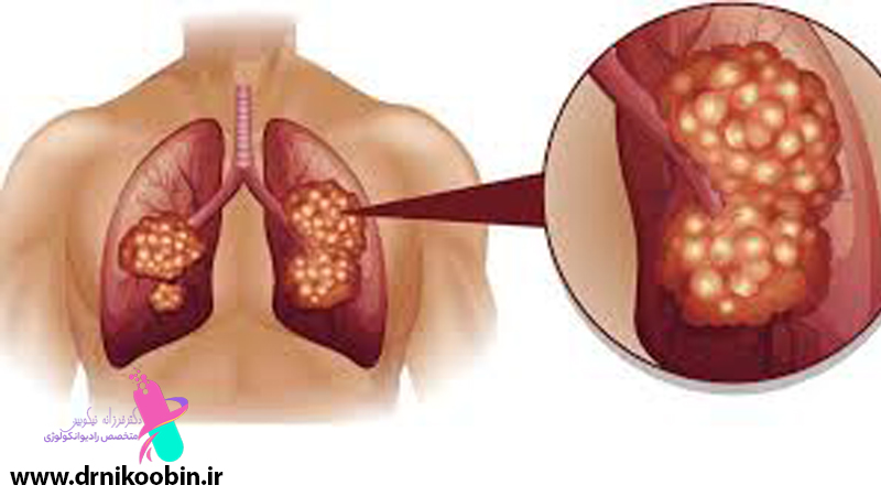 متخصص-رادیوانکولوژی-اصفهان | شیمی-درمانی-اصفهان