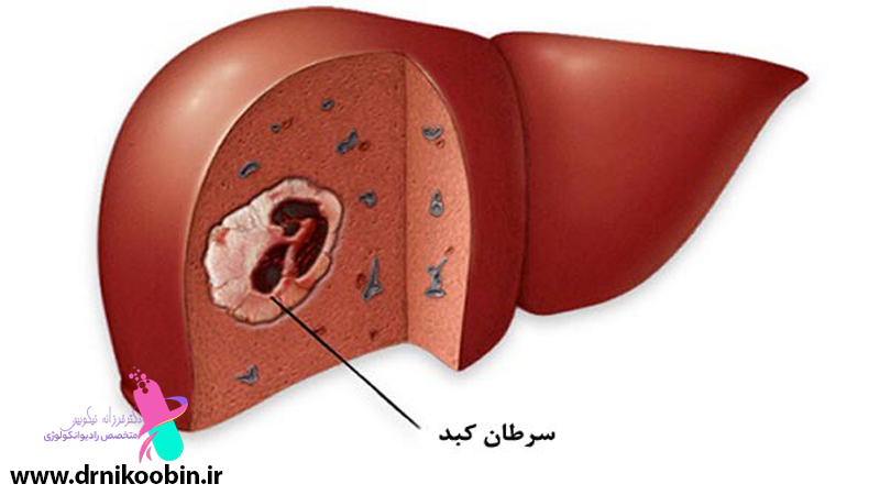 متخصص-رادیوانکولوژی-اصفهان | شیمی-درمانی-اصفهان | دکتر-فرزانه-نیکوبین