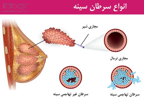 دکتر فرزانه نیکوبین | متخصص رادیوانکولوژی اصفهان | هورمون درمانی اصفهان | شیمی درمانی اصفهان