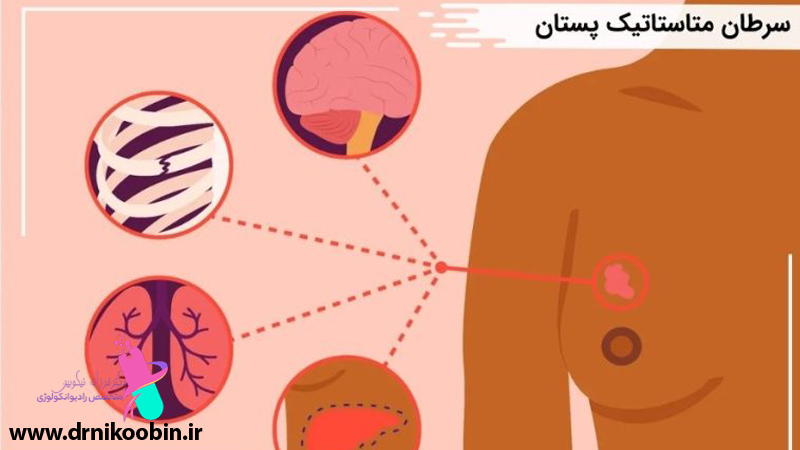 دکتر فرزانه نیکوبین | متخصص رادیوانکولوژی اصفهان | پرتو درمانی اصفهان