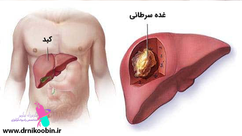 متخصص رادیوانکولوژی اصفهان | متخصص شیمی درمانی اصفهان | دکتر فرزانه نیکوبین