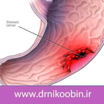 علائم سرطان دستگاه گوارش