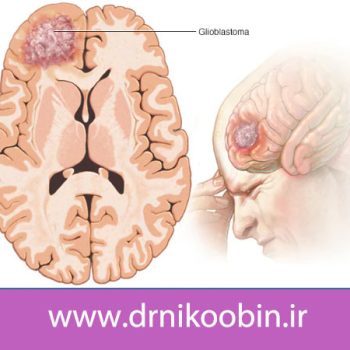 آیا تومور مغزی کشنده است