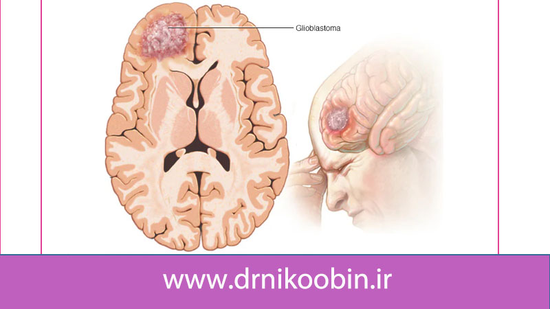 آیا تومور مغزی کشنده است
