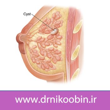علائم وجود کیست سینه در زنان