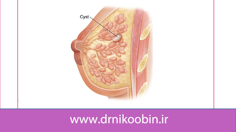 علائم وجود کیست سینه در زنان
