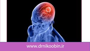 تفاوت تومور گلیوما و گلیوبلاستوما