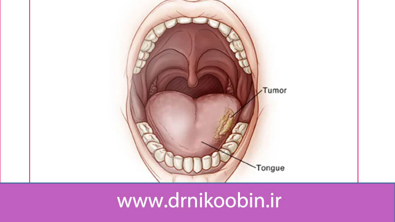 سرطان زبان